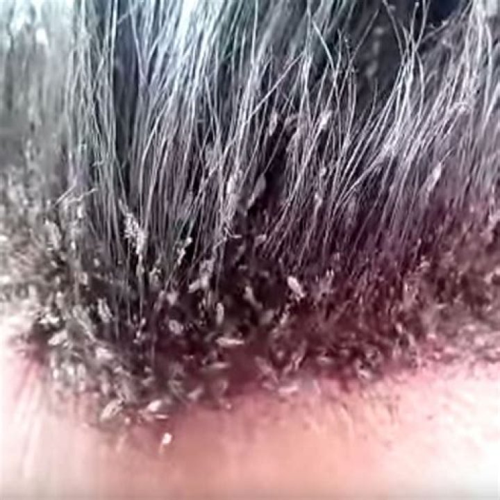 How to Get Rid of Head Lice in Nigeria